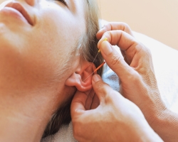 Auricular Acupuncture
